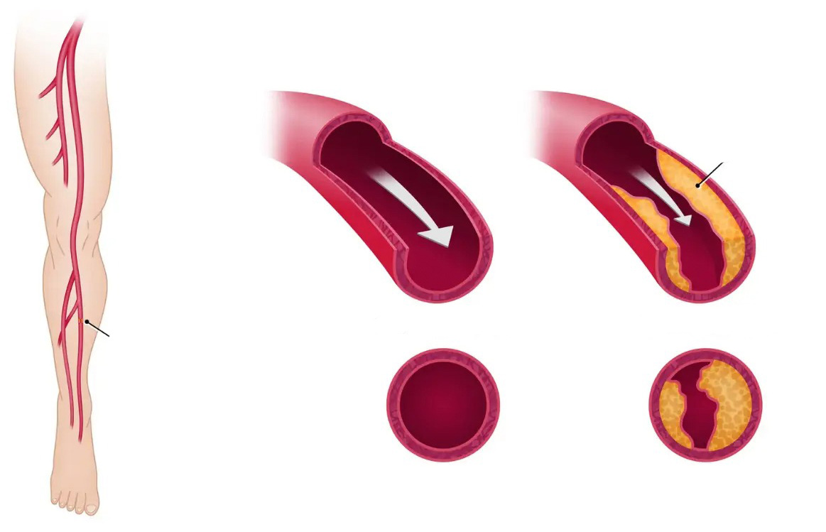 Enfermedad arterial periférica