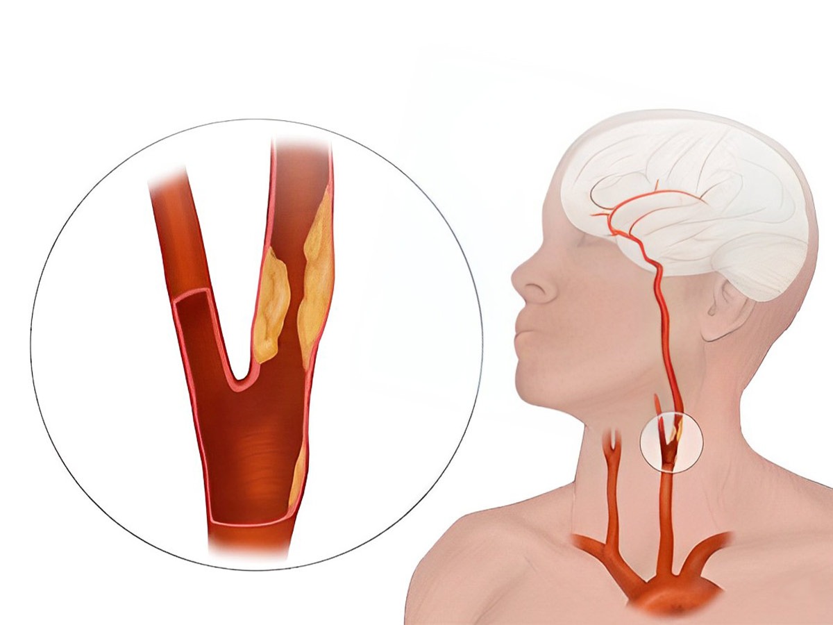 Enfermedad Carotídea